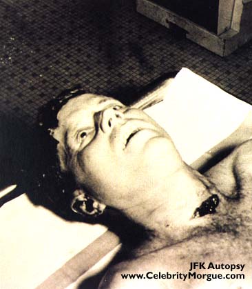 kennedy autopsy. Kennedy#39;s autopsy,